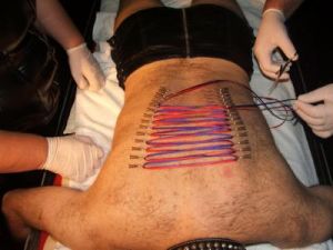 needle2